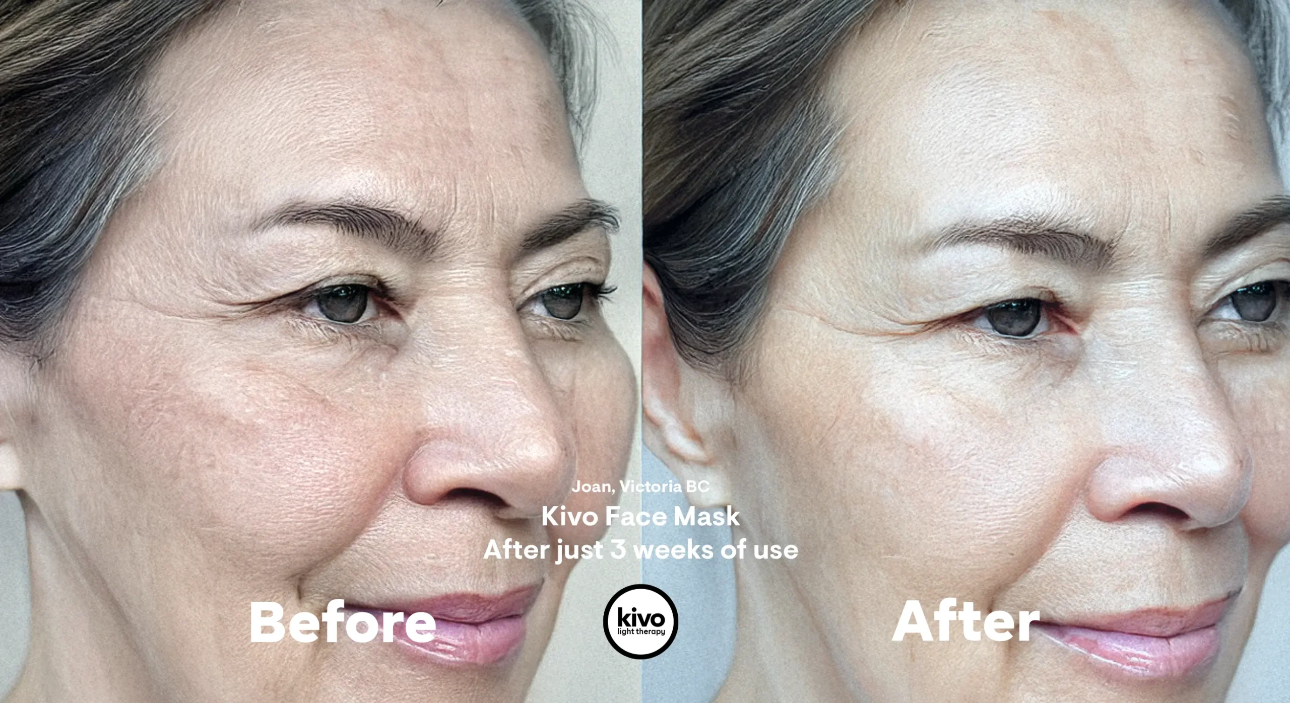 Fine Lines & Wrinkles